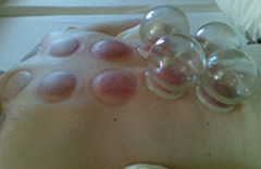 Schröpfen Bodywork-cupping