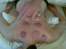 Schröpfen Chinese Cupping